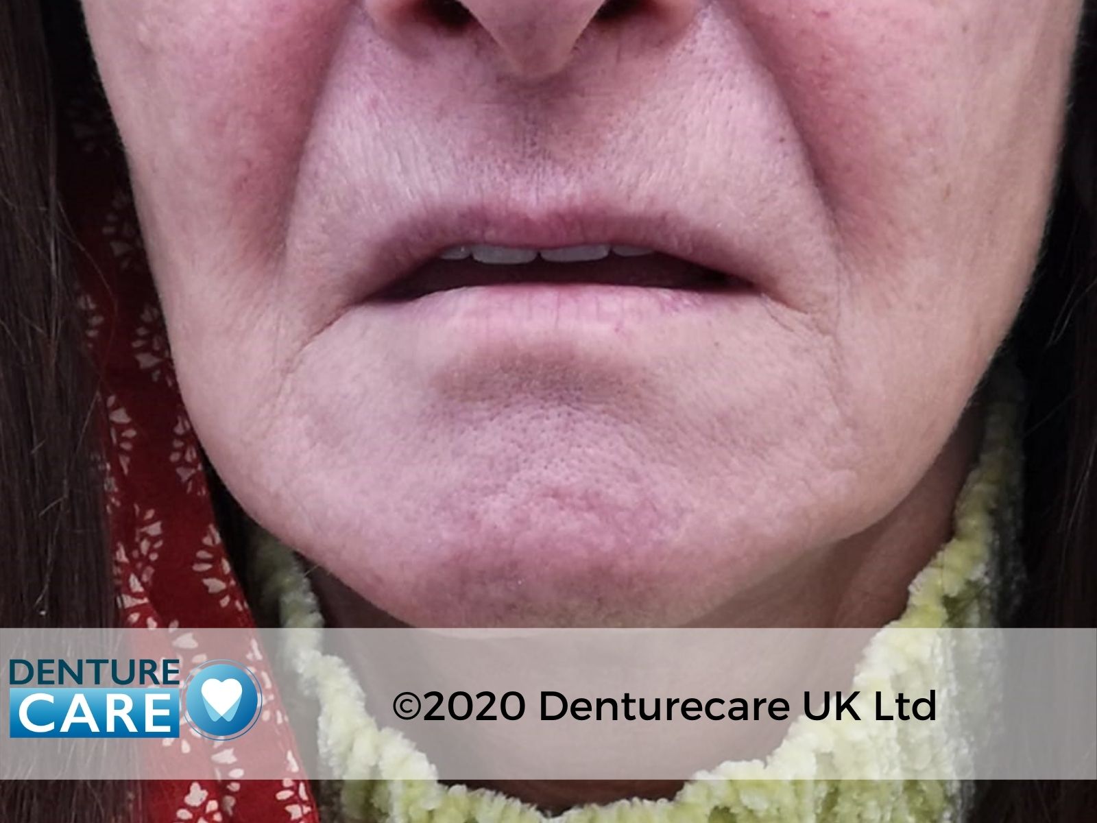 Patient’s smile before full dentures – Doncaster denture clinic