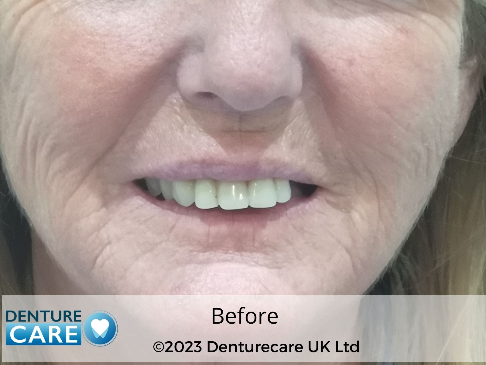 Patient’s smile before full dentures – Doncaster denture clinic