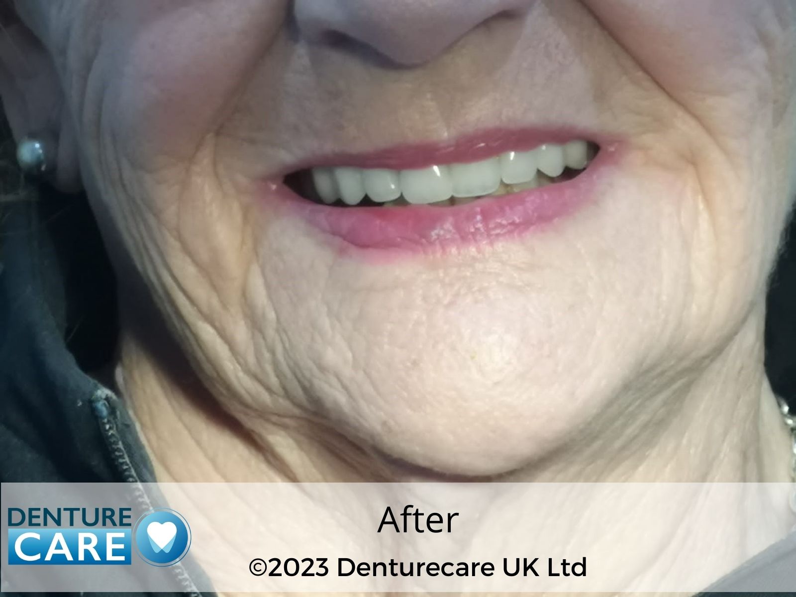 Patient’s smile after new full dentures – Doncaster denture clinic