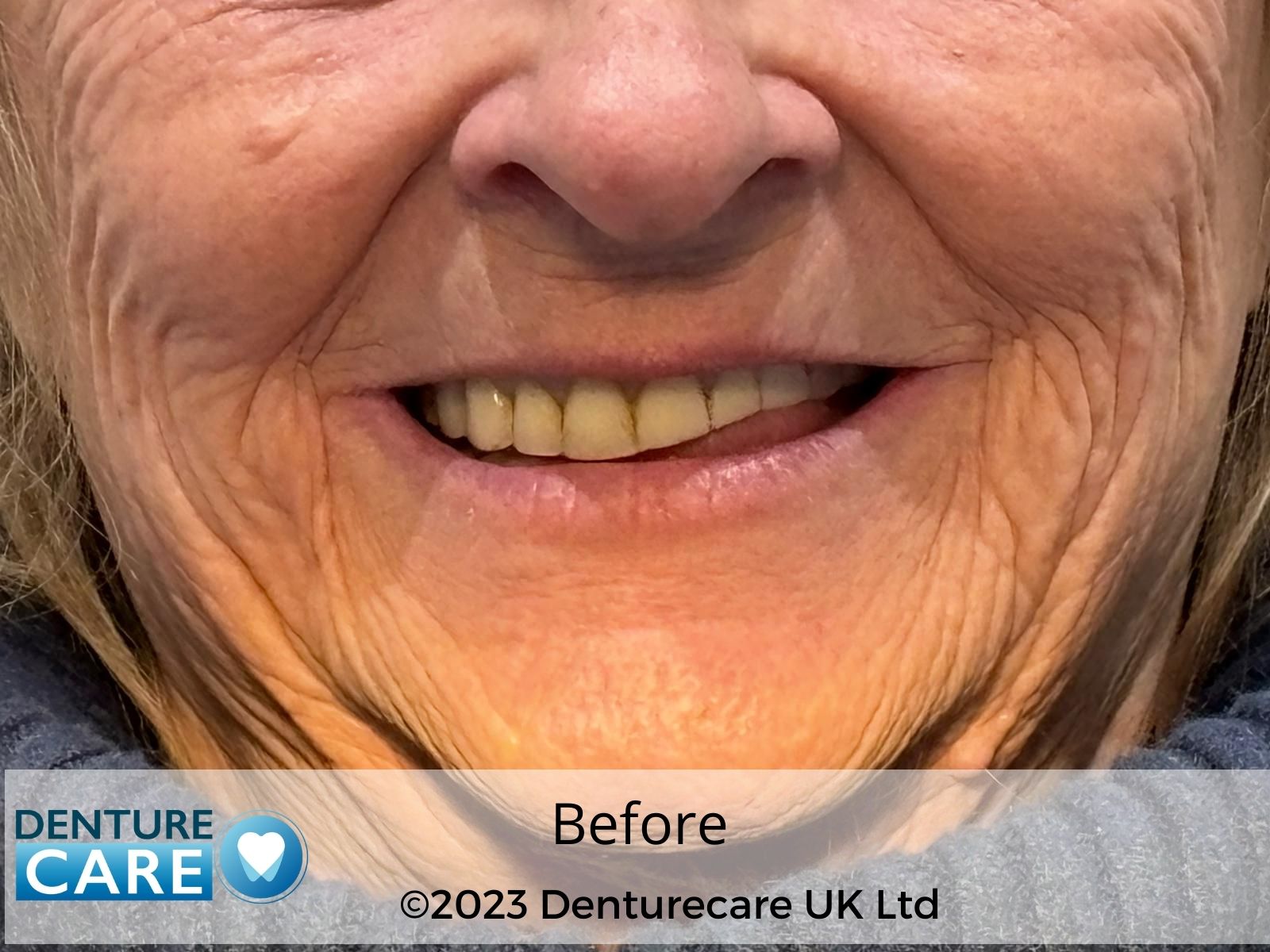 Patient’s smile before full dentures – Donaster denture clinic