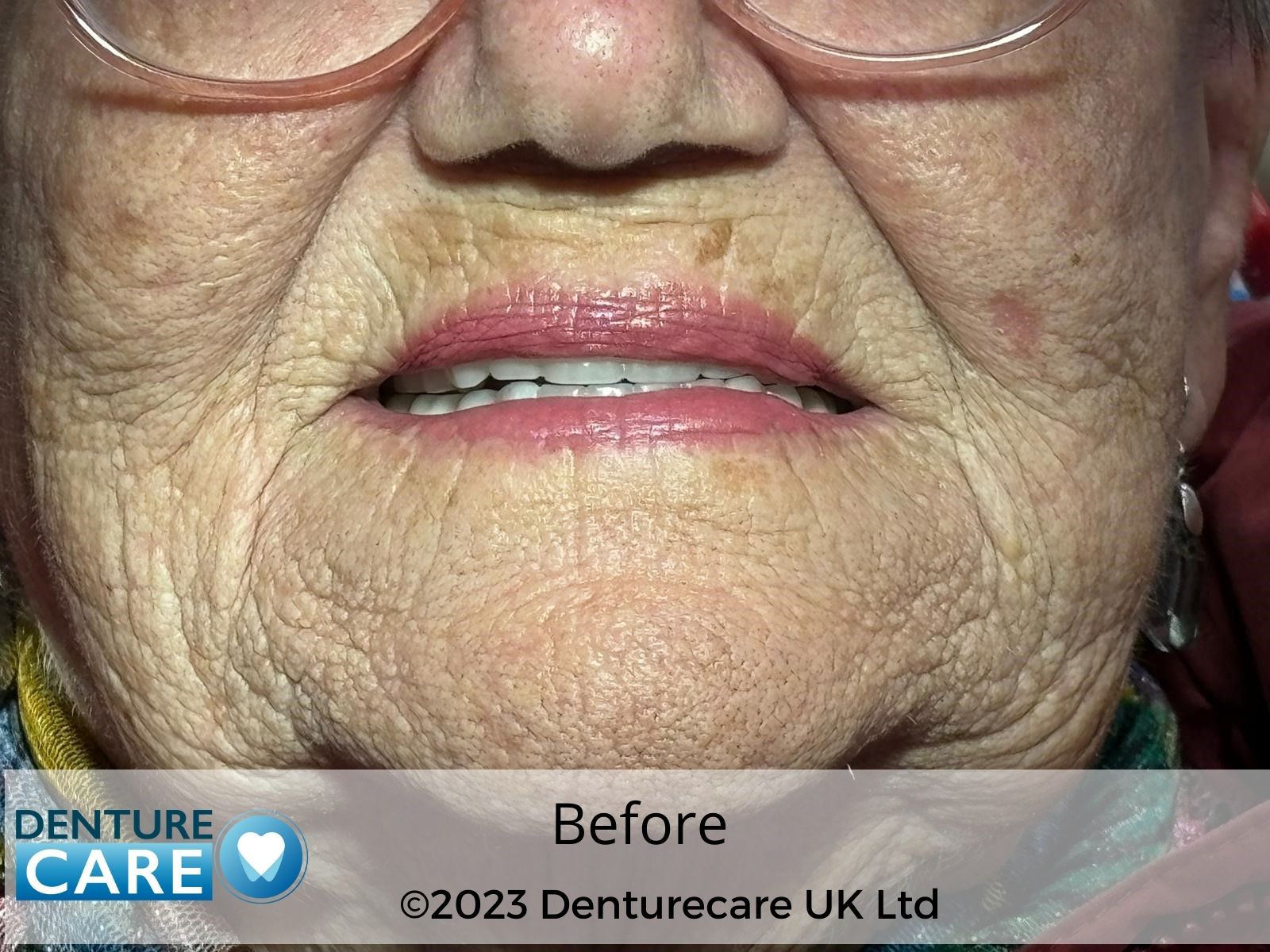 Patient’s smile before full dentures – Doncaster denture clinic