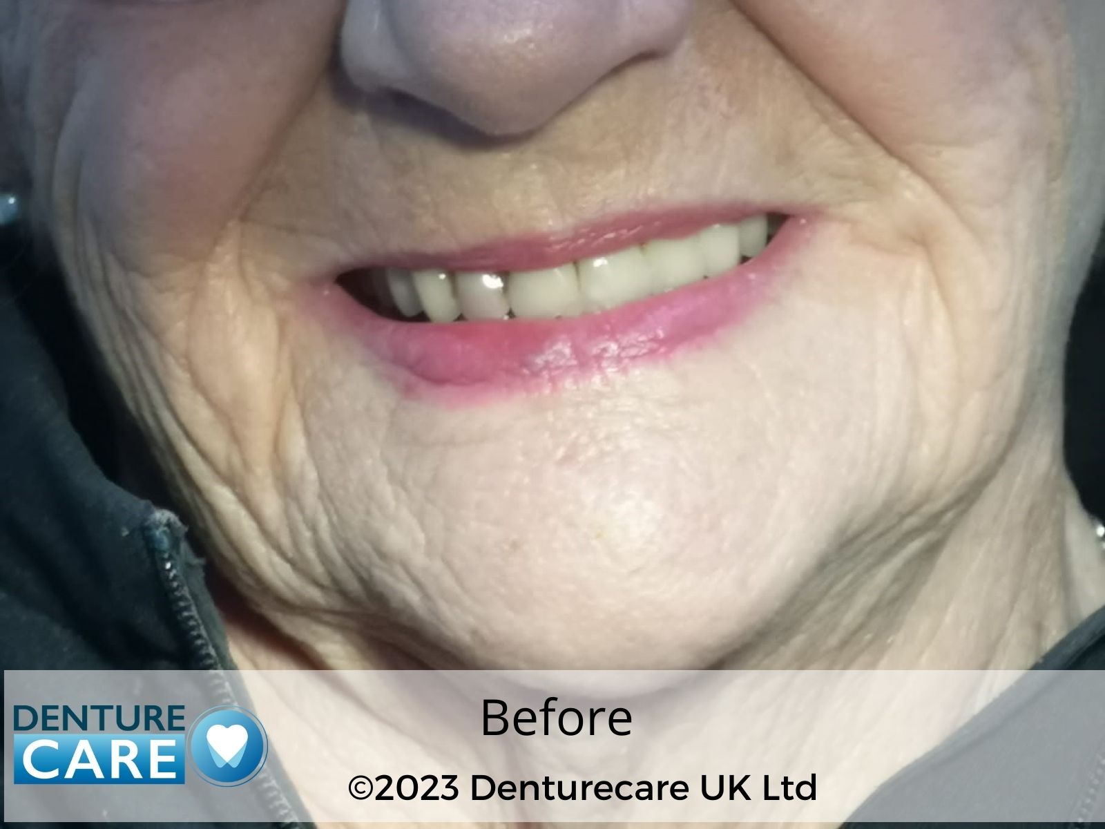 Patient’s smile before full dentures – Doncaster denture clinic