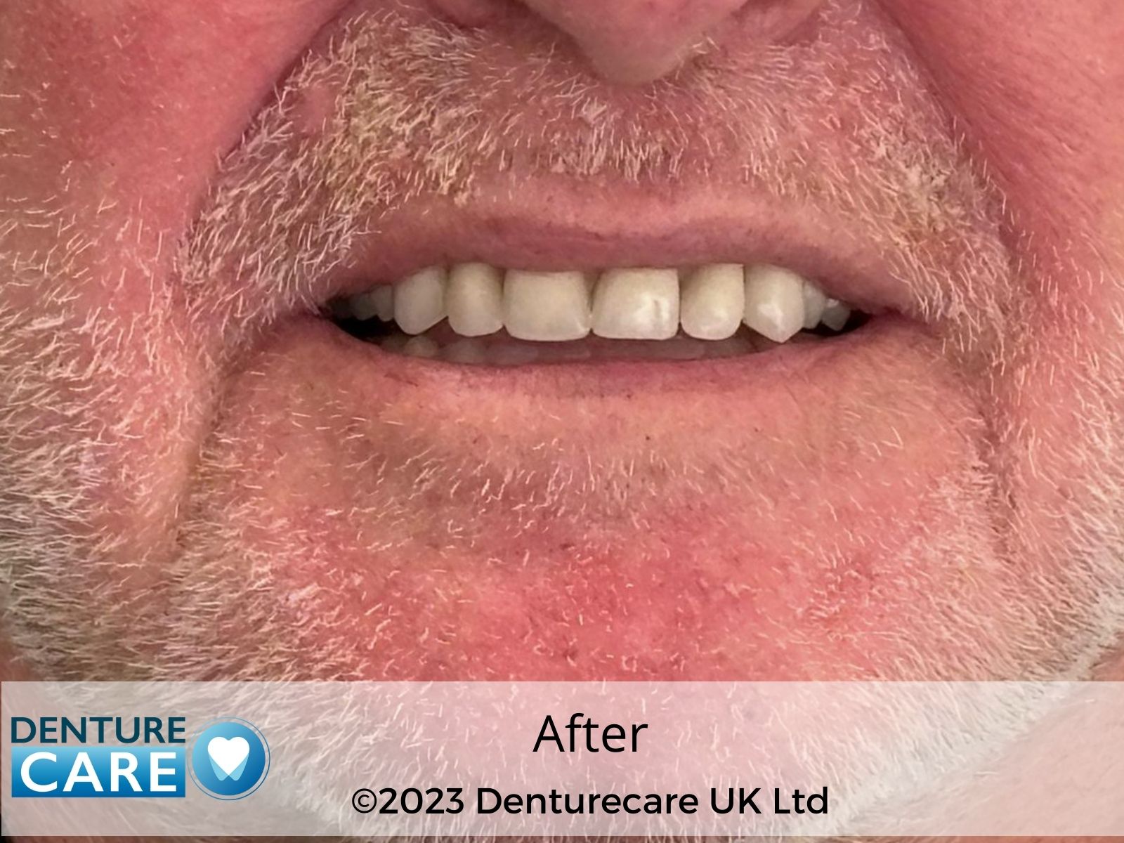 Patient’s smile after new full dentures – Doncaster denture clinic