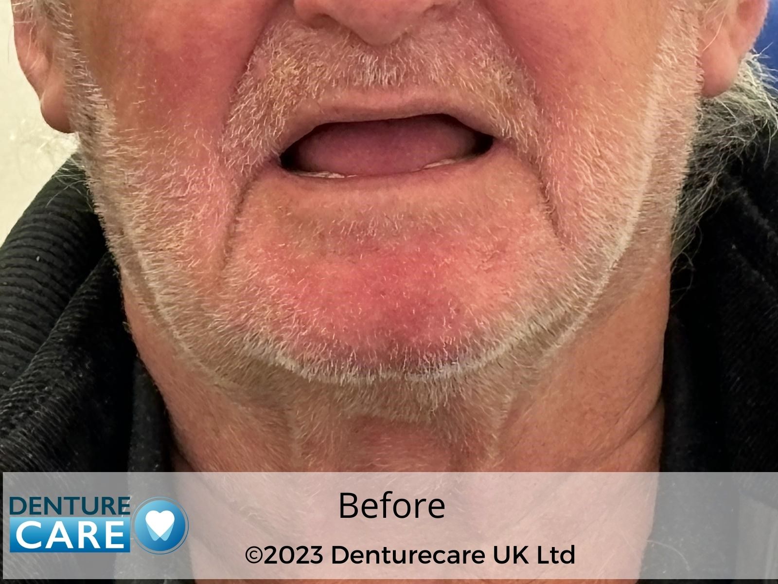 Patient’s smile before full dentures – Doncaster denture clinic