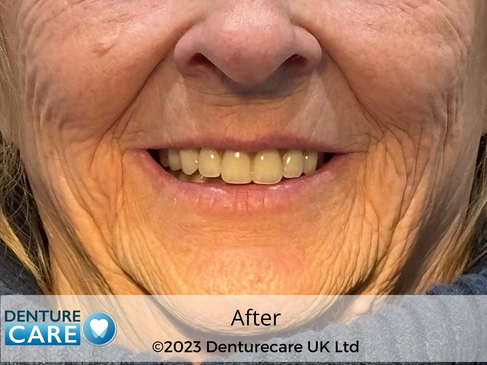 Patient’s smile after new full dentures – Doncaster denture clinic