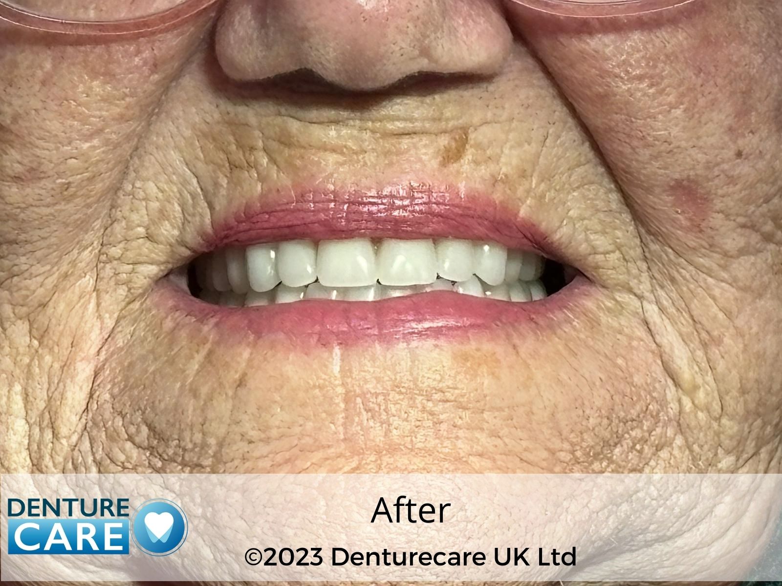 Patient’s smile after new full dentures – Doncaster denture clinic