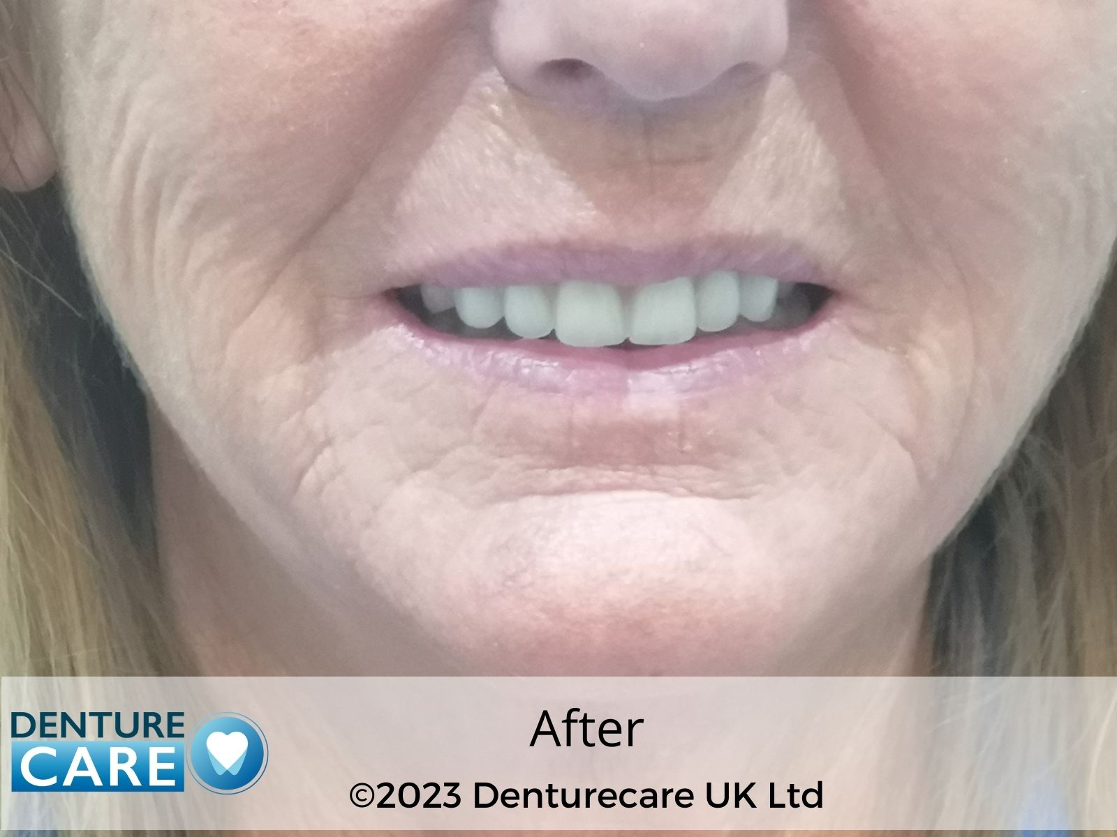 Patient’s smile after new full dentures – Doncaster denture clinic