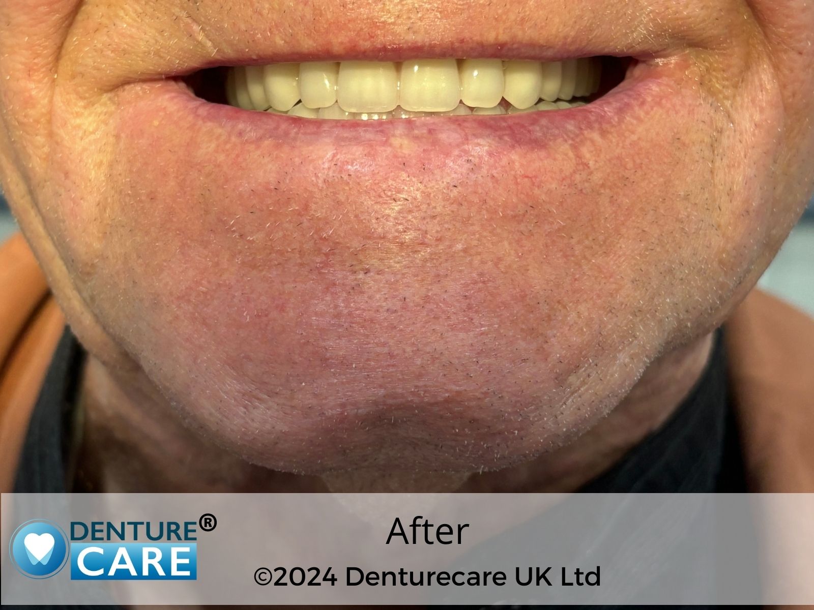 Patient’s smile after full dentures – Doncaster denture clinic