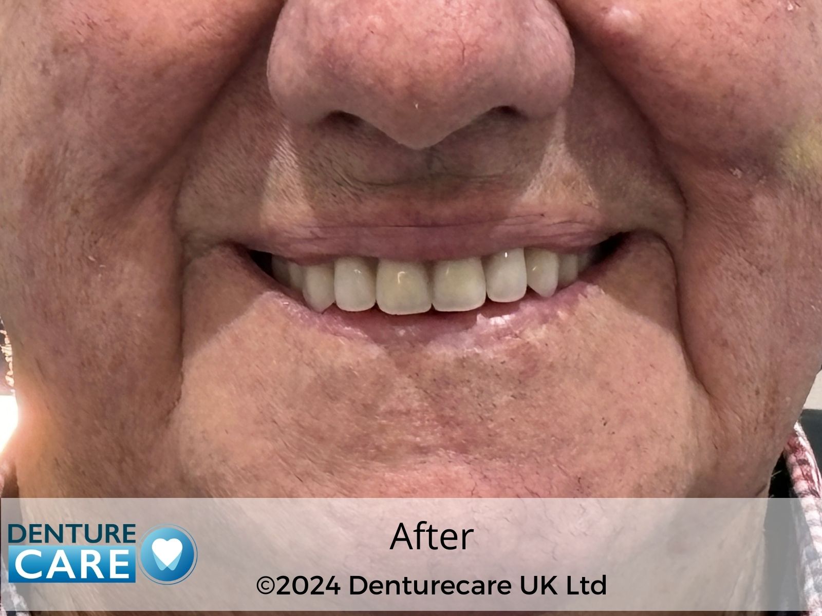 Patient’s smile after new full dentures – Doncaster denture clinic