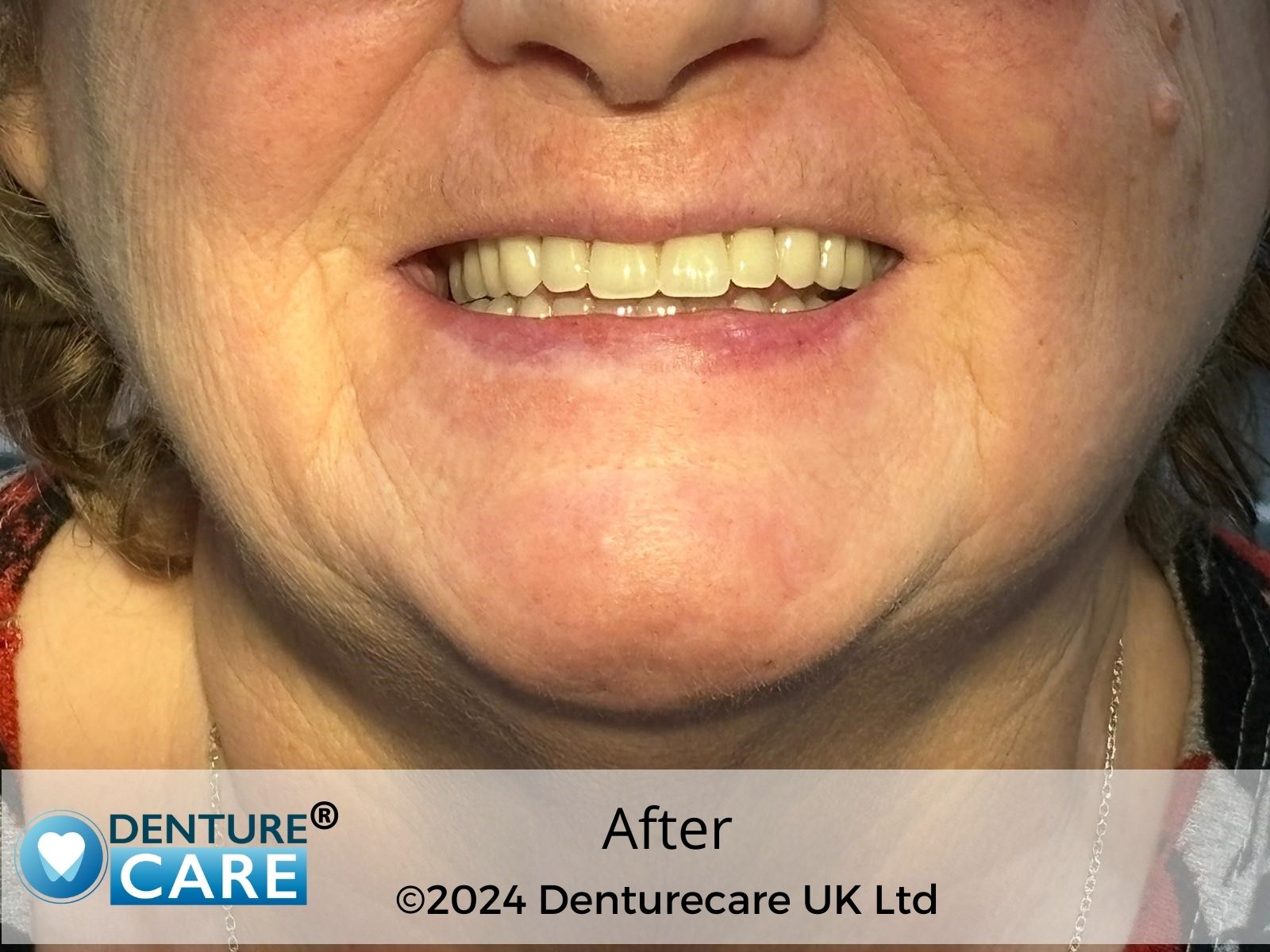 Patient’s smile after new full dentures – Doncaster denture clinic