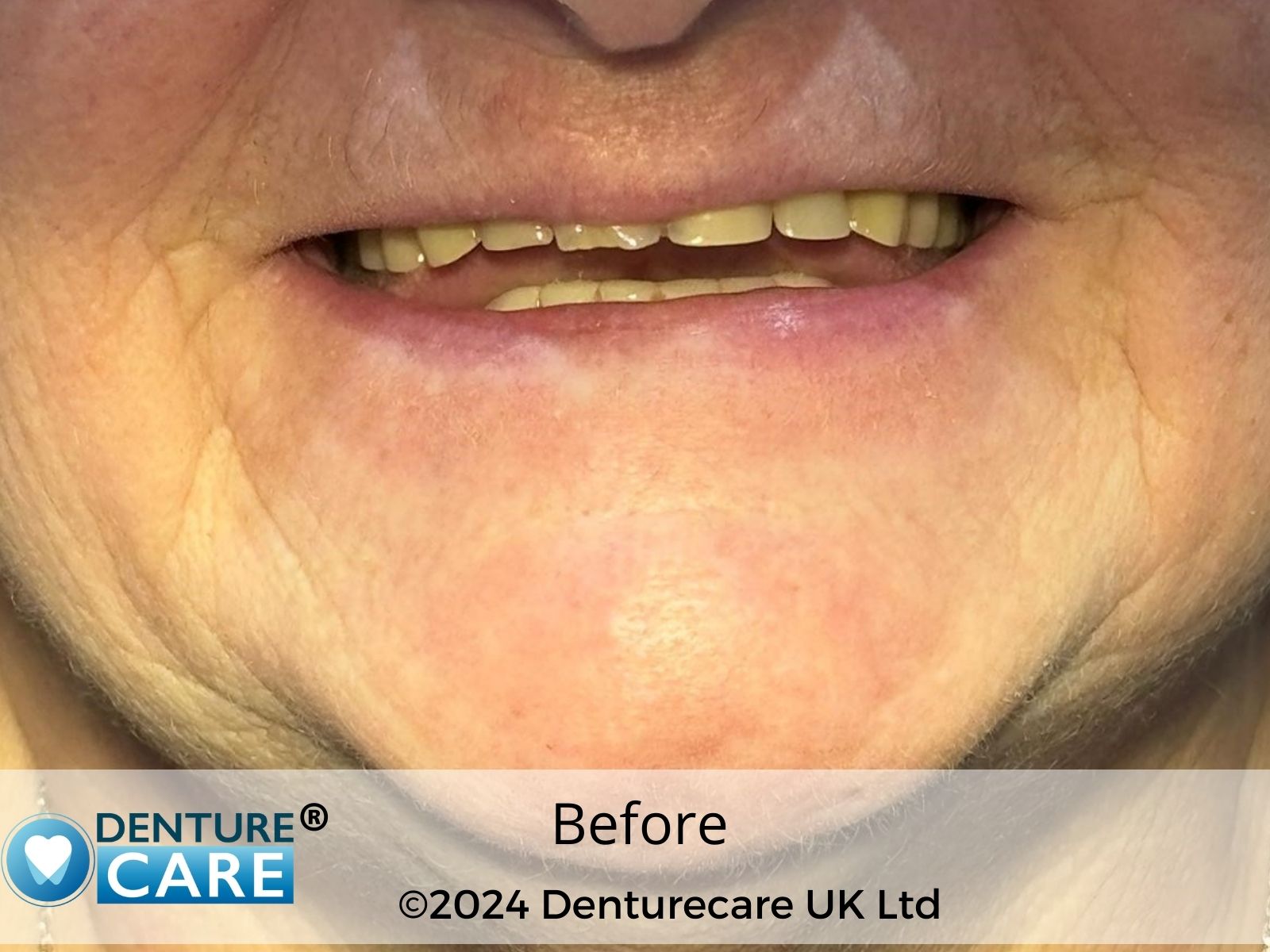 Patient’s smile before full dentures – Chesterfield denture clinic