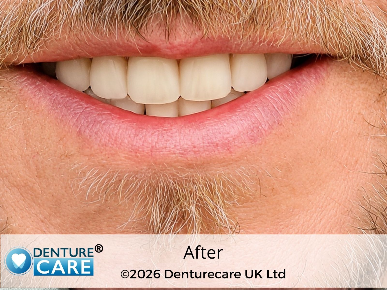 Patient’s smile after full upper dentures – BARNSLEY Denture clinic