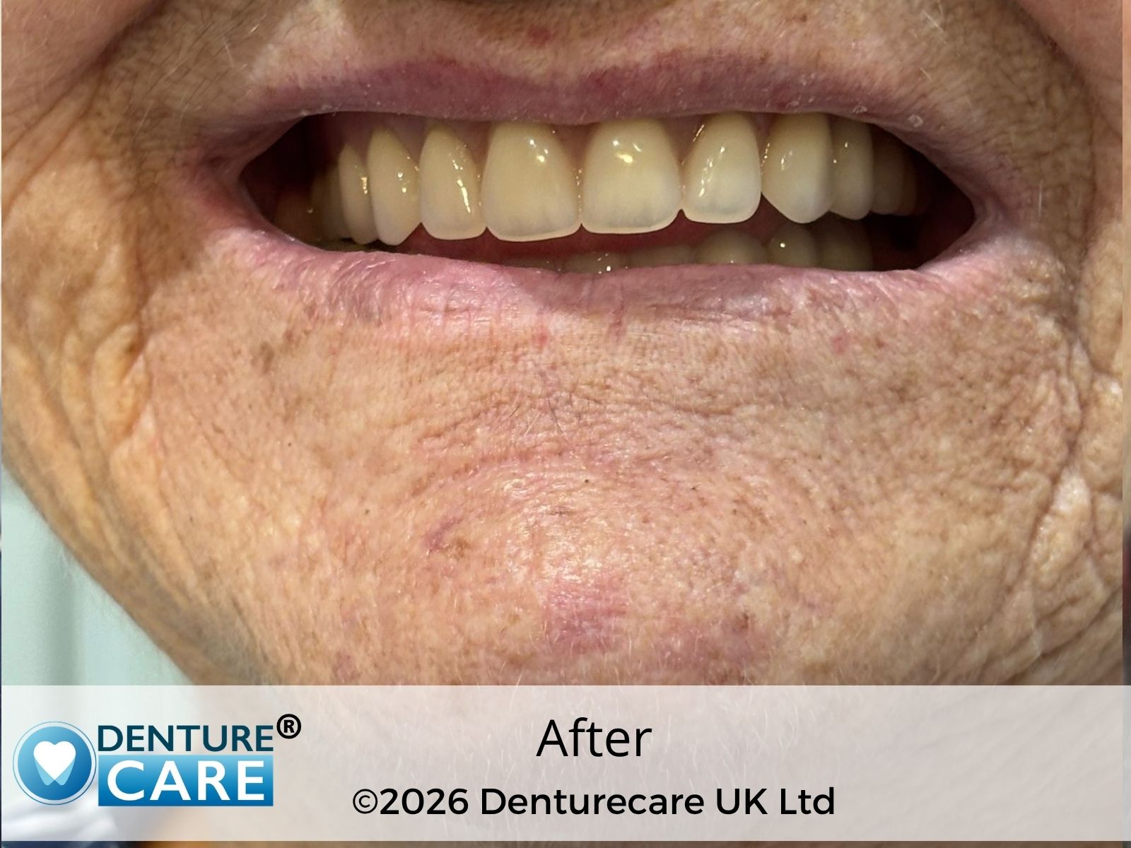 Patient’s smile after new full dentures – Doncaster denture clinic