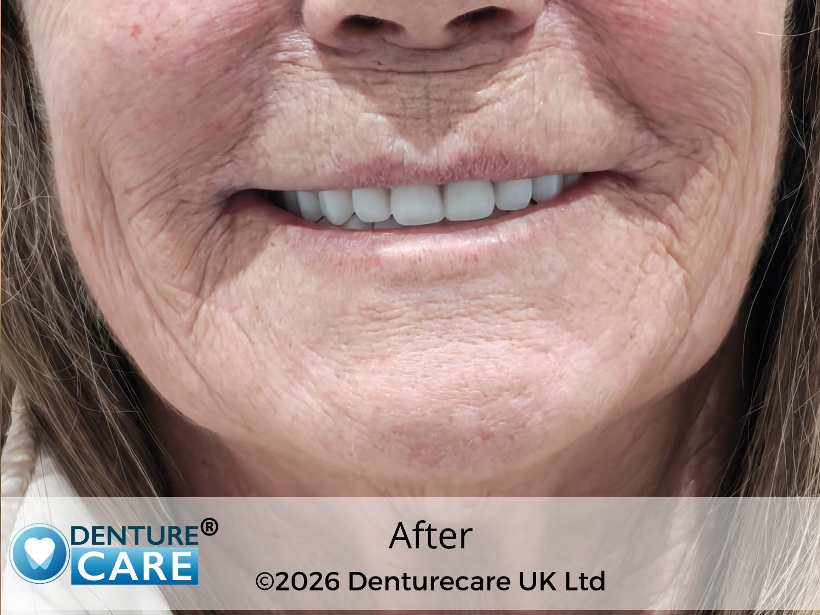 Patient’s smile after full dentures – Doncaster denture clinic