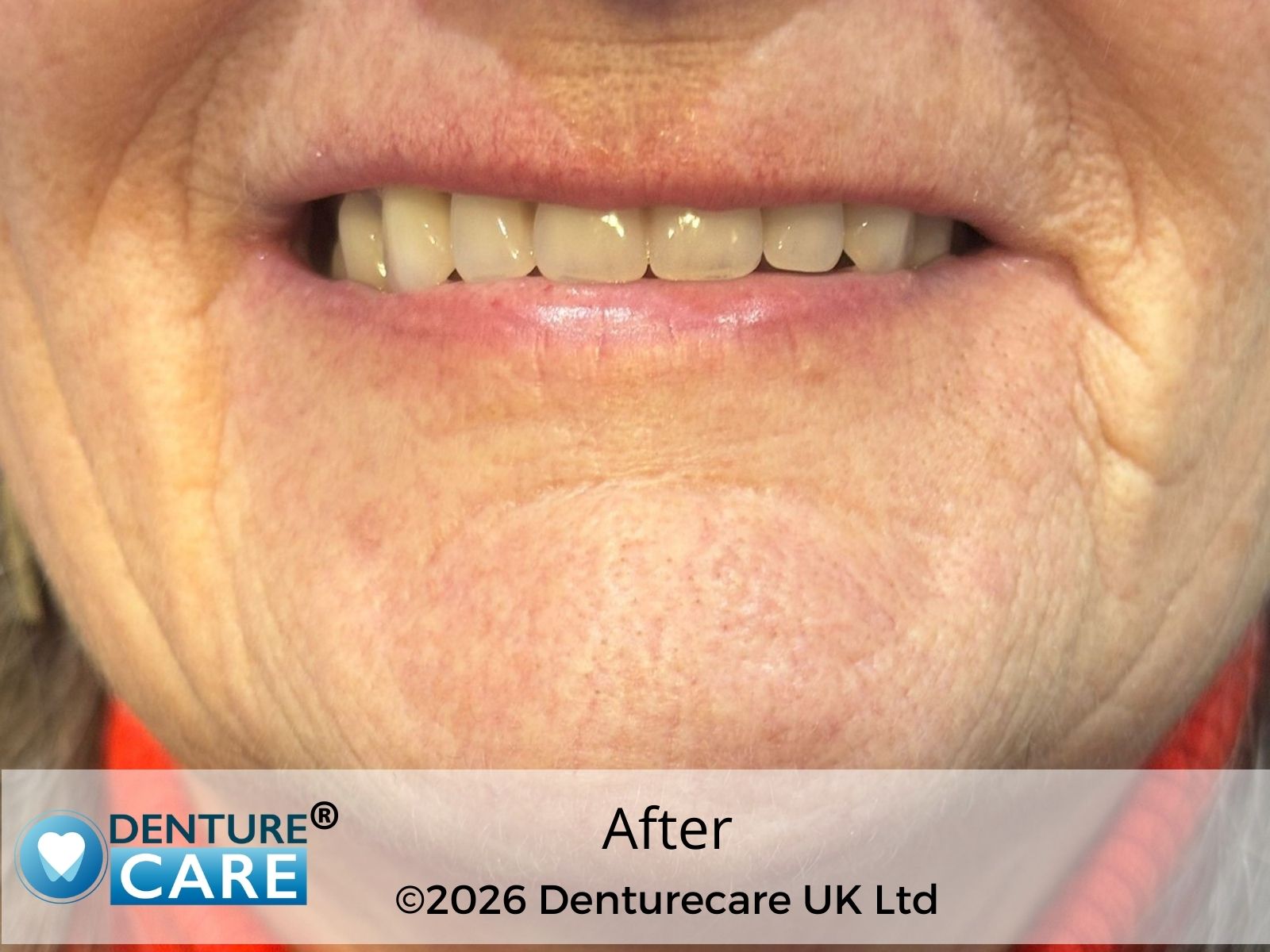 Patient’s smile after full upper dentures – Doncaster clinic