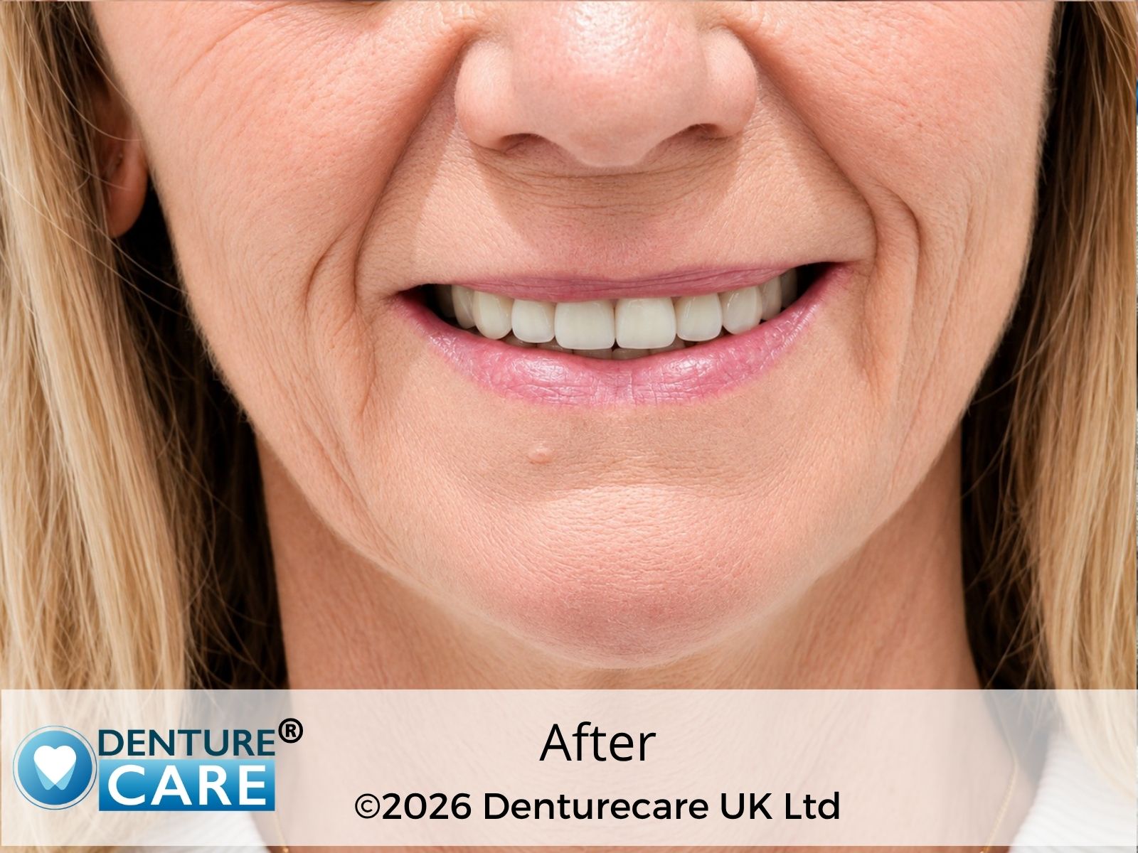 Patient’s smile after full dentures – Doncaster denture clinic