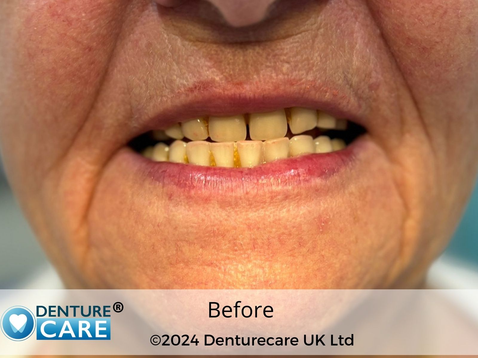 Patient’s smile before full dentures – Doncaster denture clinic