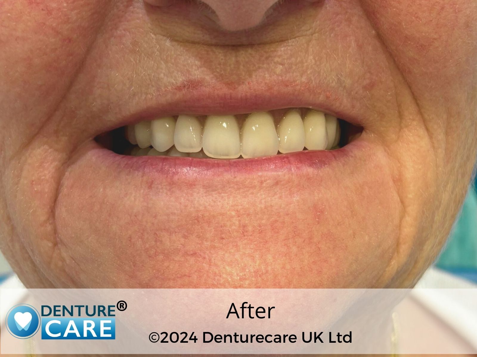 Patient’s smile after full dentures – Barnsley denture clinic