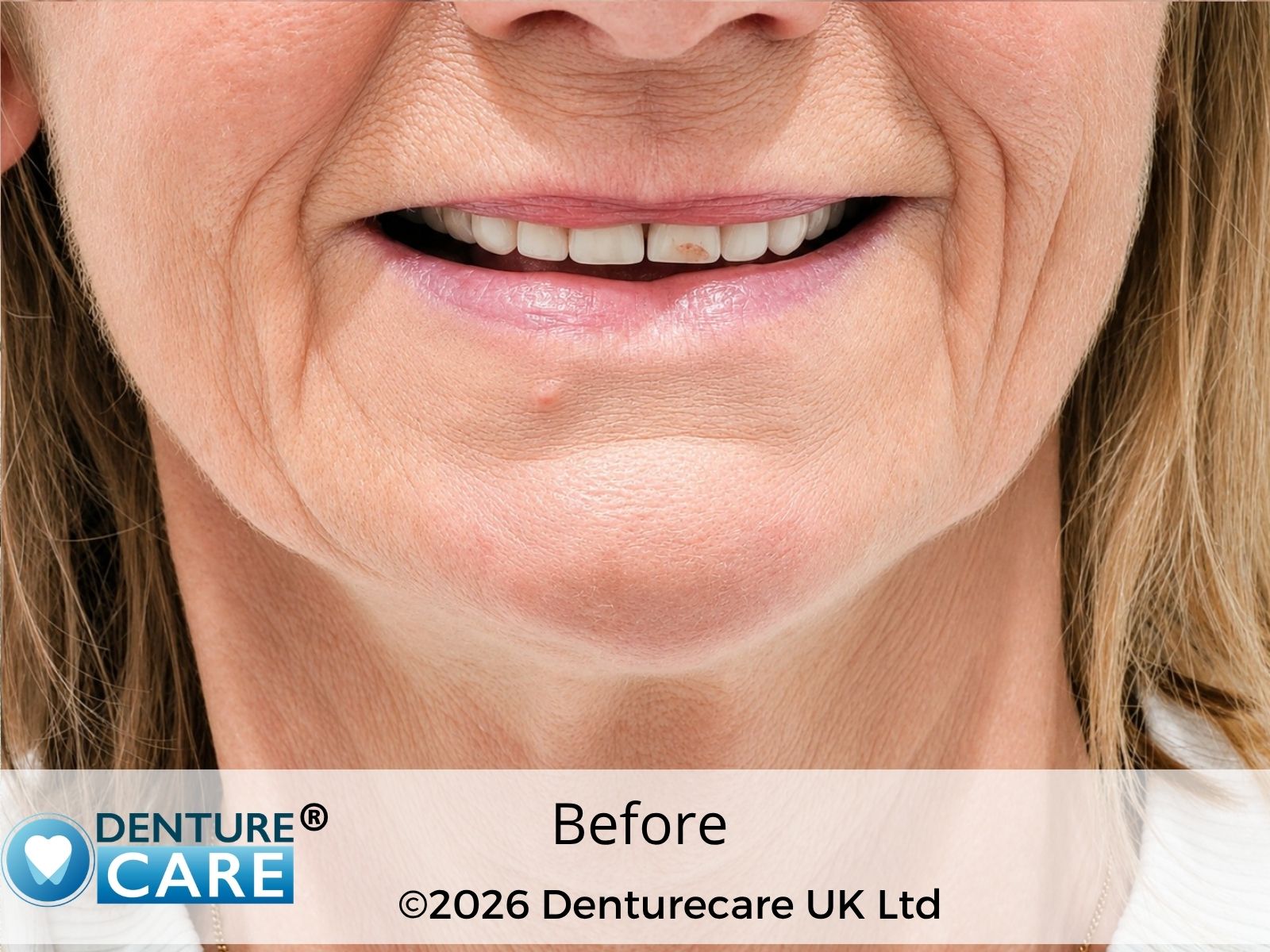 Patient’s smile before new full dentures – Doncaster denture clinic