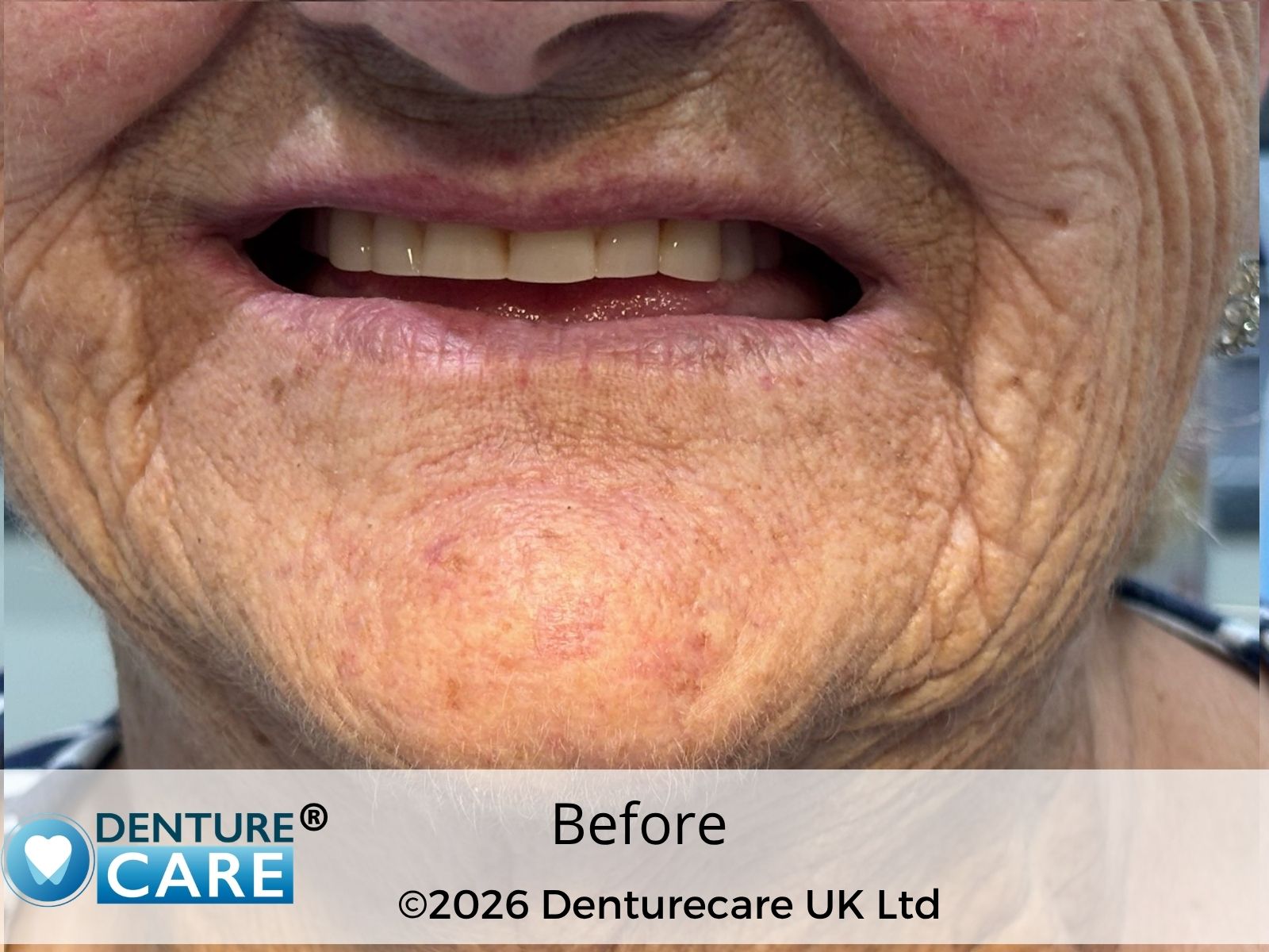 Patient’s smile before full dentures – Doncaster denture clinic