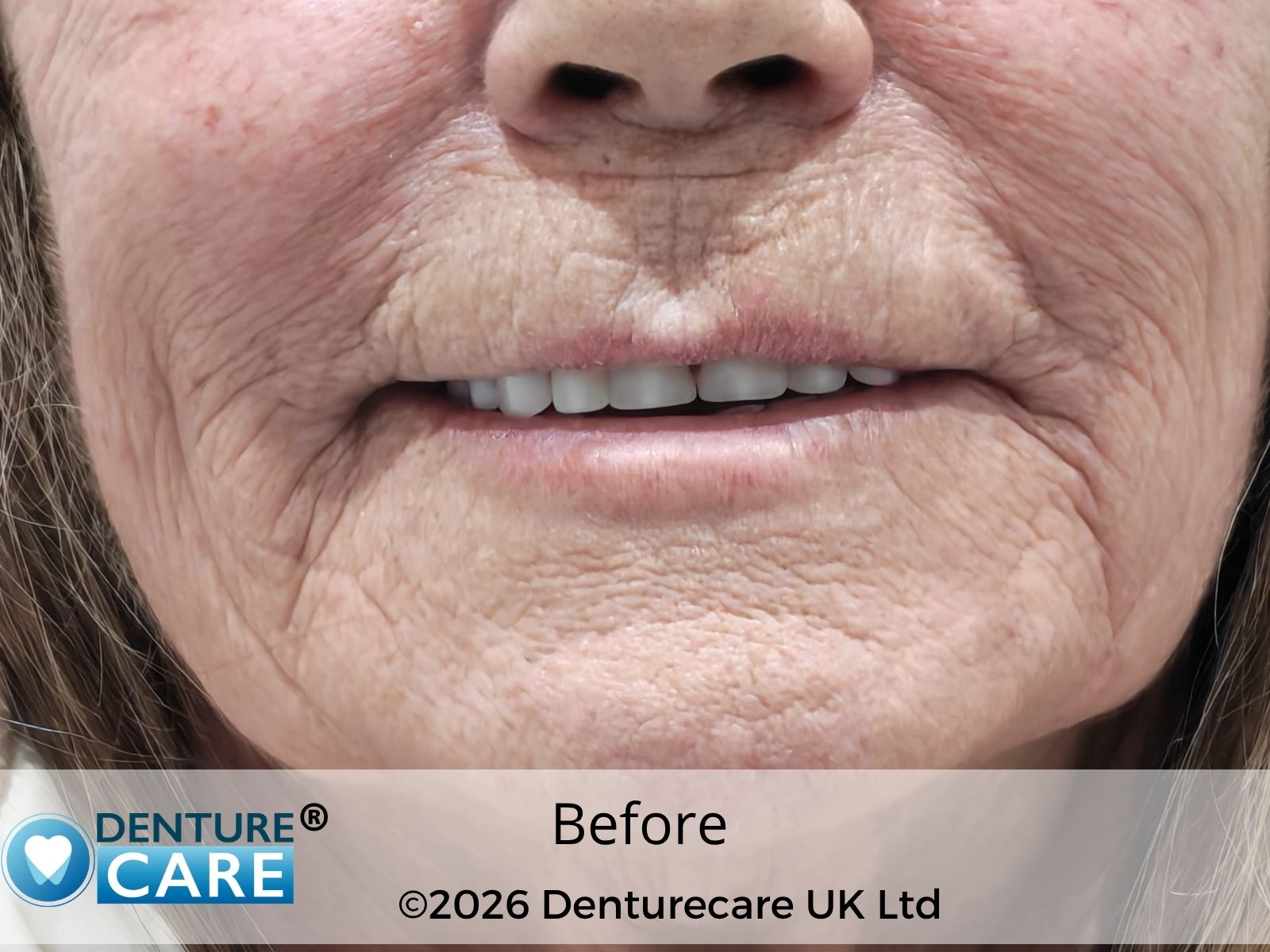 Patient’s smile before full dentures – Doncaster denture clinic