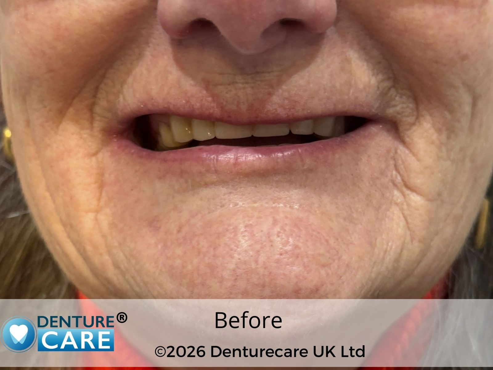 Patient’s smile before full upper dentures – Doncaster clinic