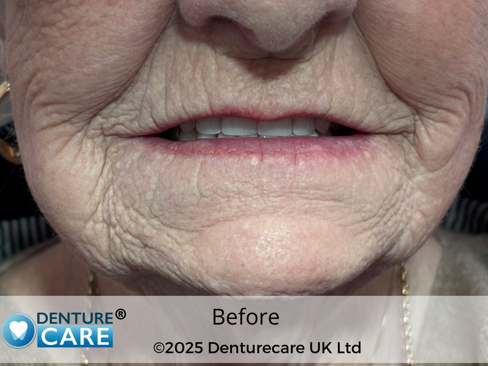 Patient’s smile before full dentures – Doncaster denture clinic