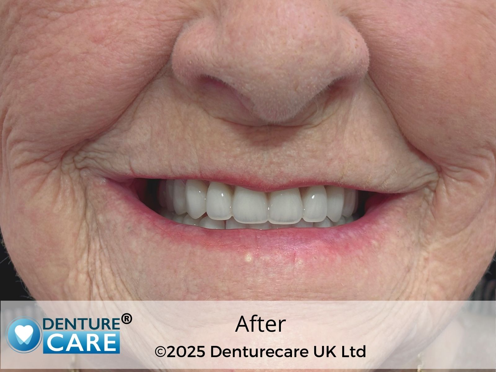 Patient’s smile after new full dentures – Doncaster denture clinic