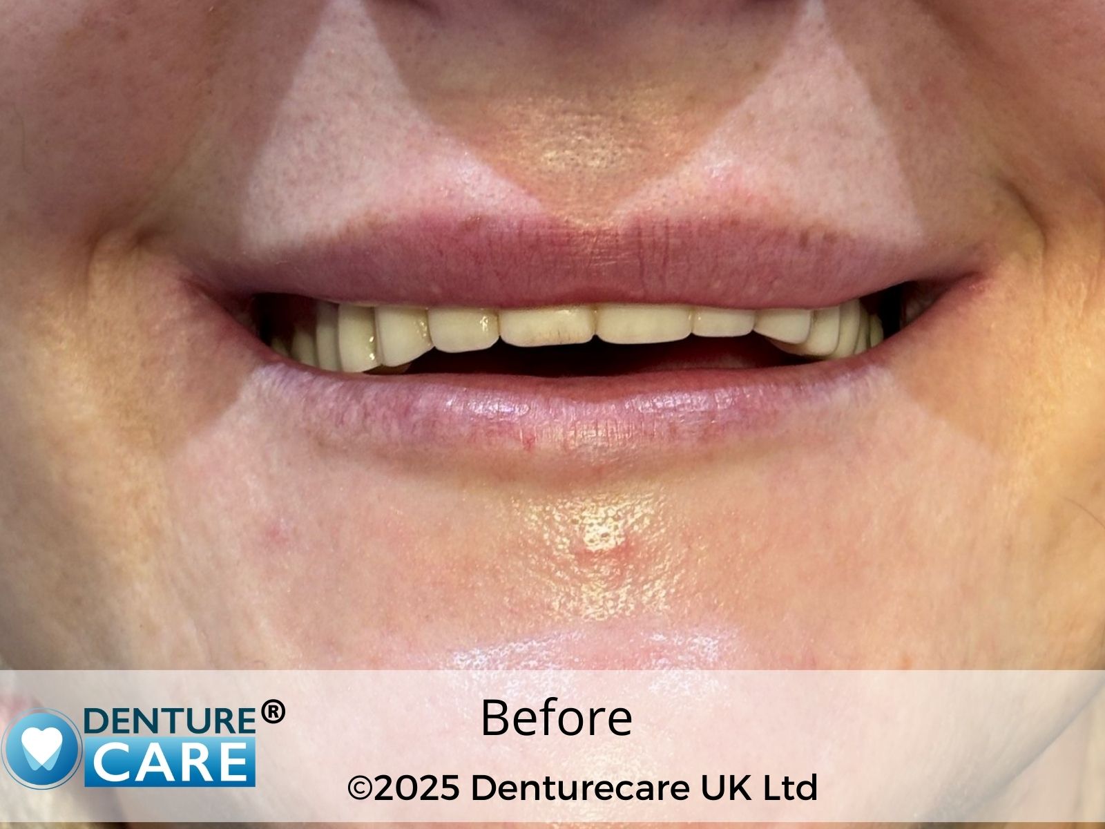 Patient’s smile before full dentures – Barnsley denture clinic