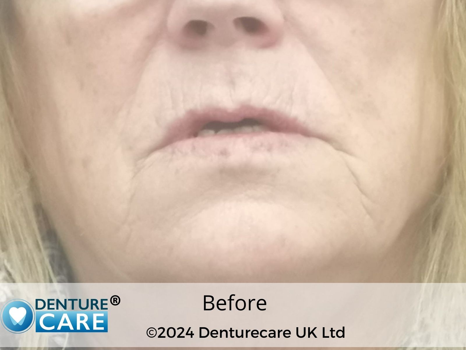 Patient’s smile before full dentures – Barnsley denture clinic