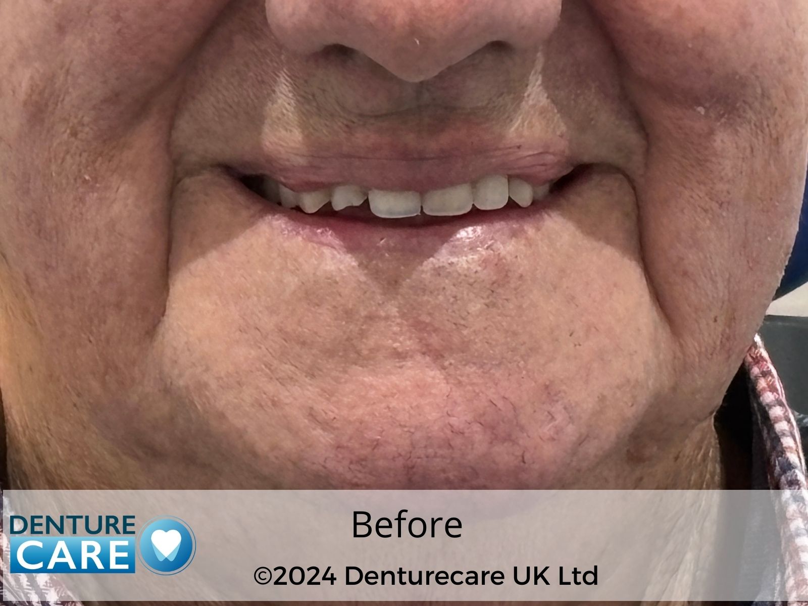 Patient’s smile before full dentures – Doncaster denture clinic