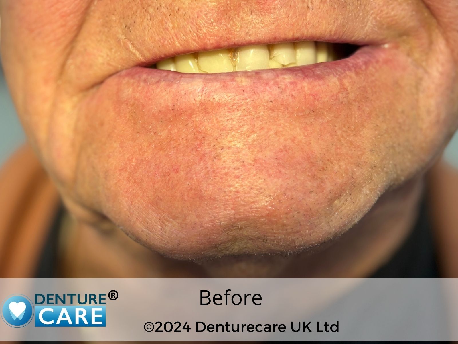 Patient’s smile before full dentures – Doncaster denture clinic