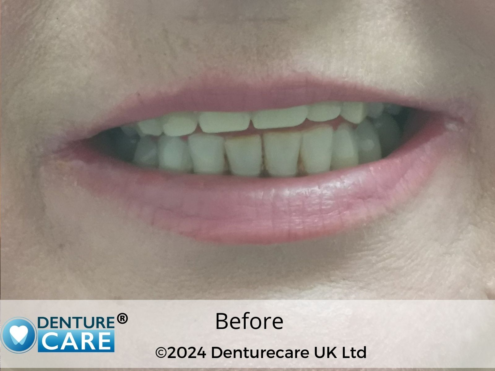 Patient’s smile before full upper dentures – Barnsley denture clinic