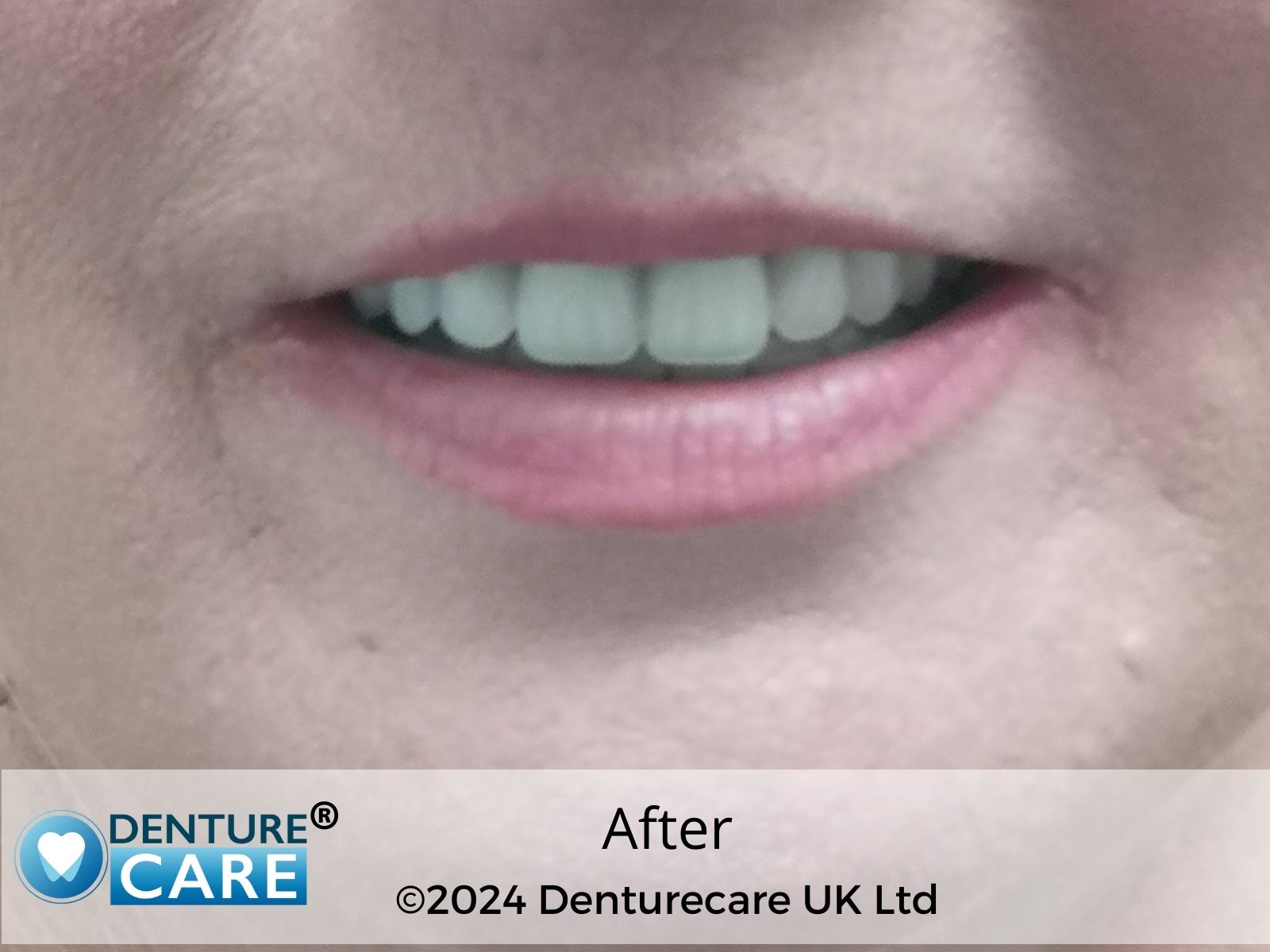 Restored smile after custom dentures – Denturecare UK Chesterfield
